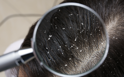 Causes of an Itchy Scalp – Is It Head Lice?