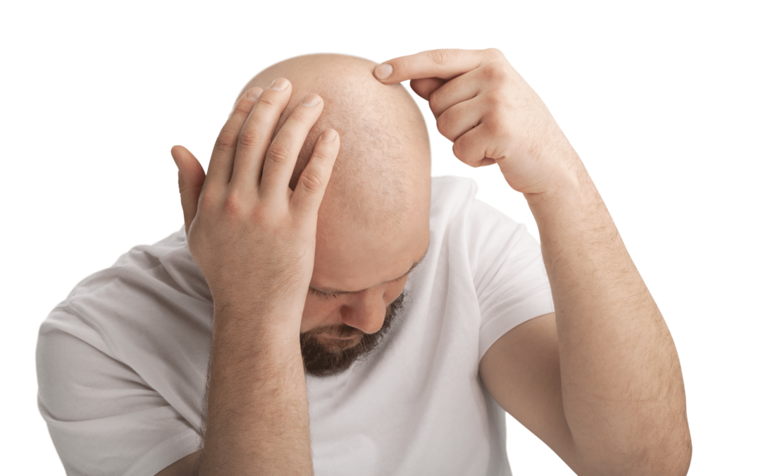 Bald Men and Head Lice: Debunking Myths and Understanding Risks